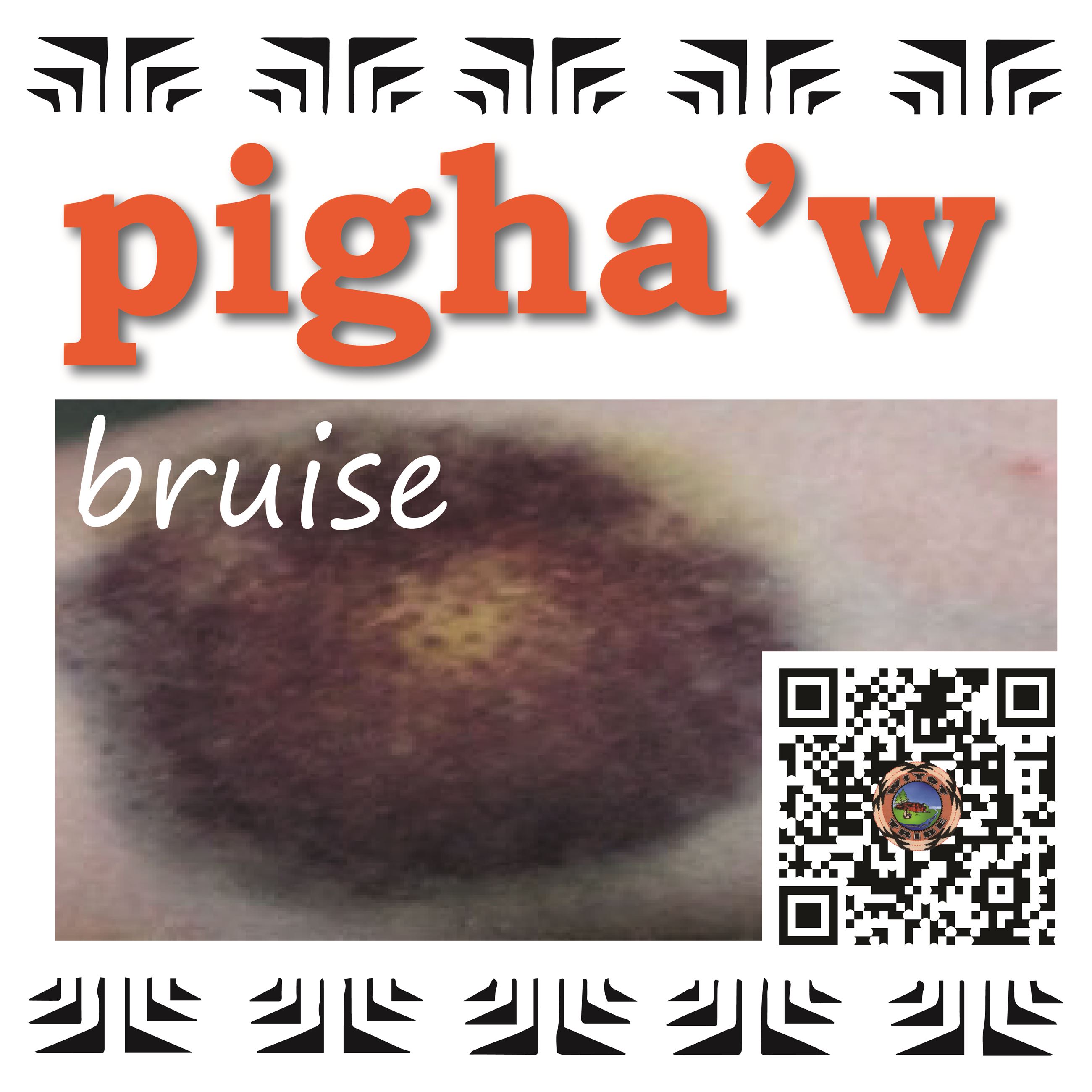 pigha’w (bruise)